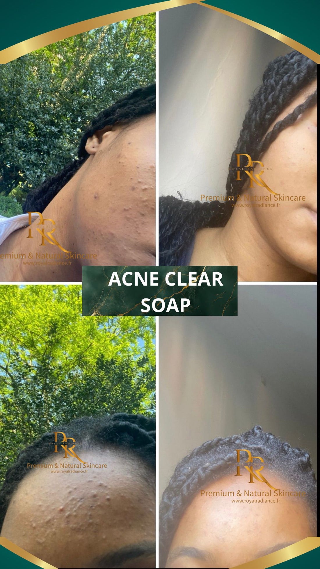 Acne Clear Bar Soap – 150 g